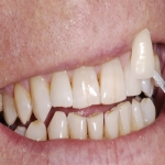 Aesthetic Dentistry Procedures in Pontefract 7