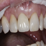 Aesthetic Dentistry Procedures in Pontefract 8